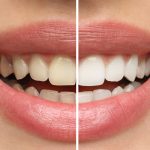 dental-teeth-whitening-graphic